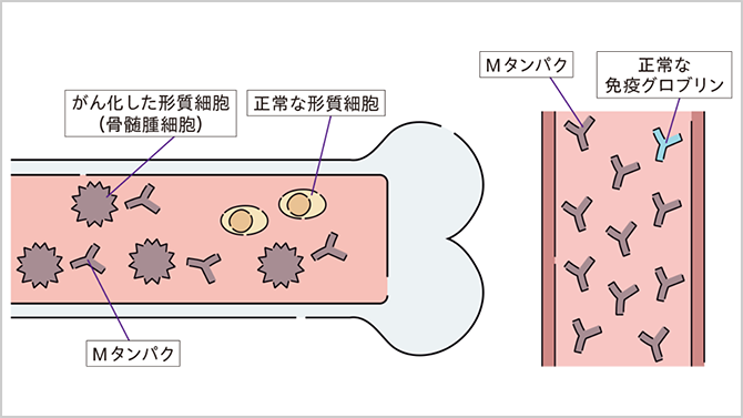 多発性骨髄腫とは、腫瘍（がん）が骨髄に多発する病気