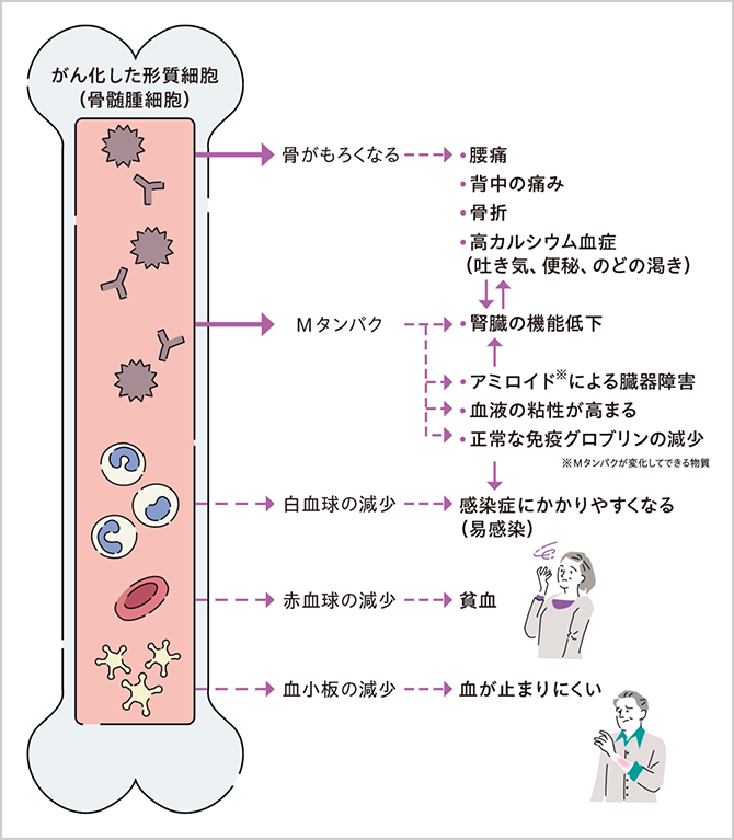 多発性骨髄腫の主な症状