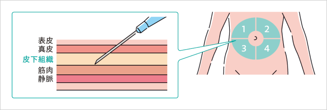 ダラキューロの投与方法